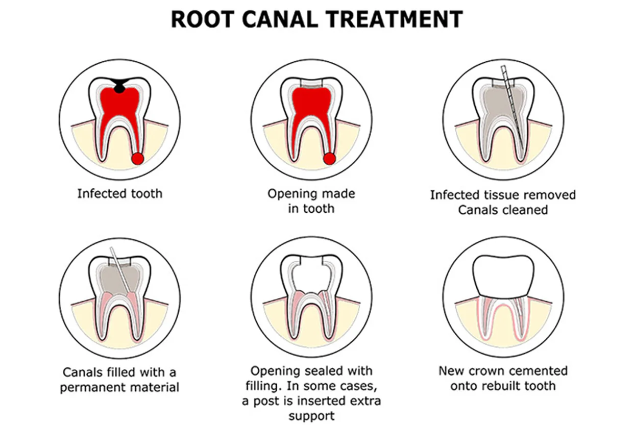 Root Canal Treatment (RCT)