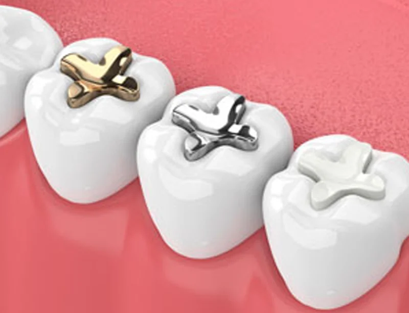 Dental Fillings