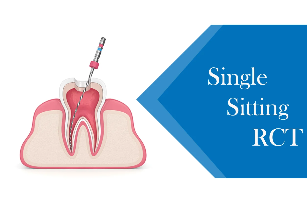 Single Sitting RCT