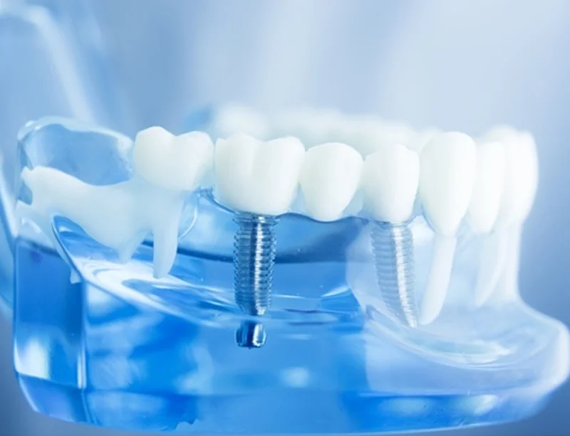 Dental Implants